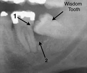 38 year old wisdom tooth patient